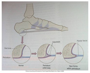 Posterior Calcaneal Spur